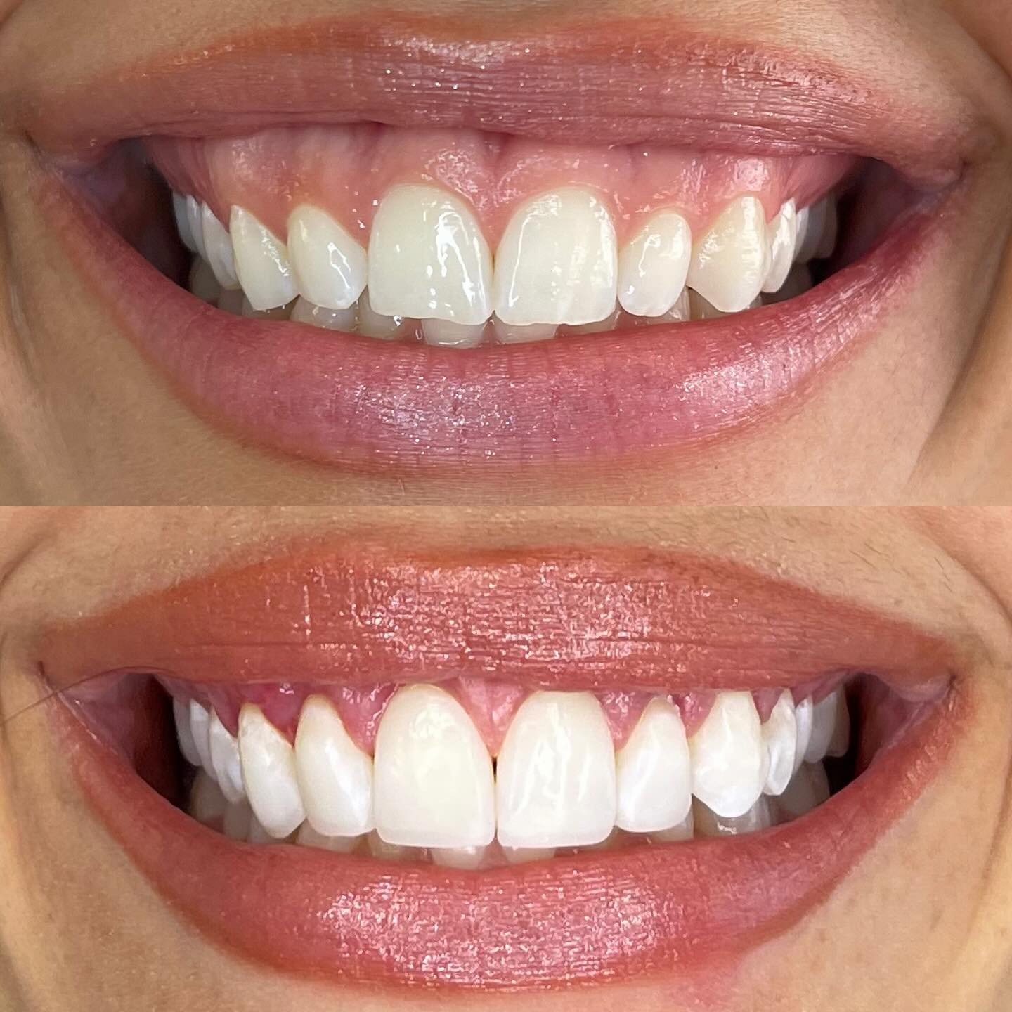 Comparativo clínico do sorriso antes e depois de um planejamento estético integrado