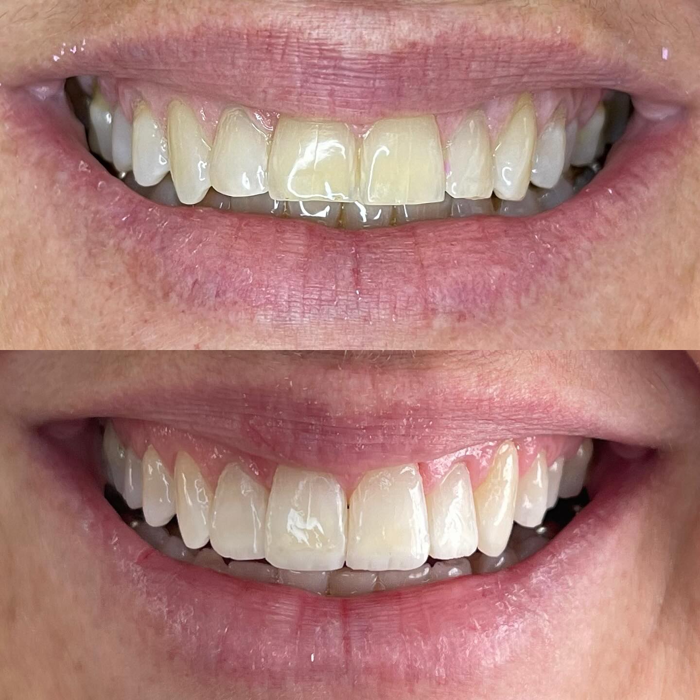 Comparativo clínico do sorriso antes e depois de recontorno em resina e clareamento caseiro