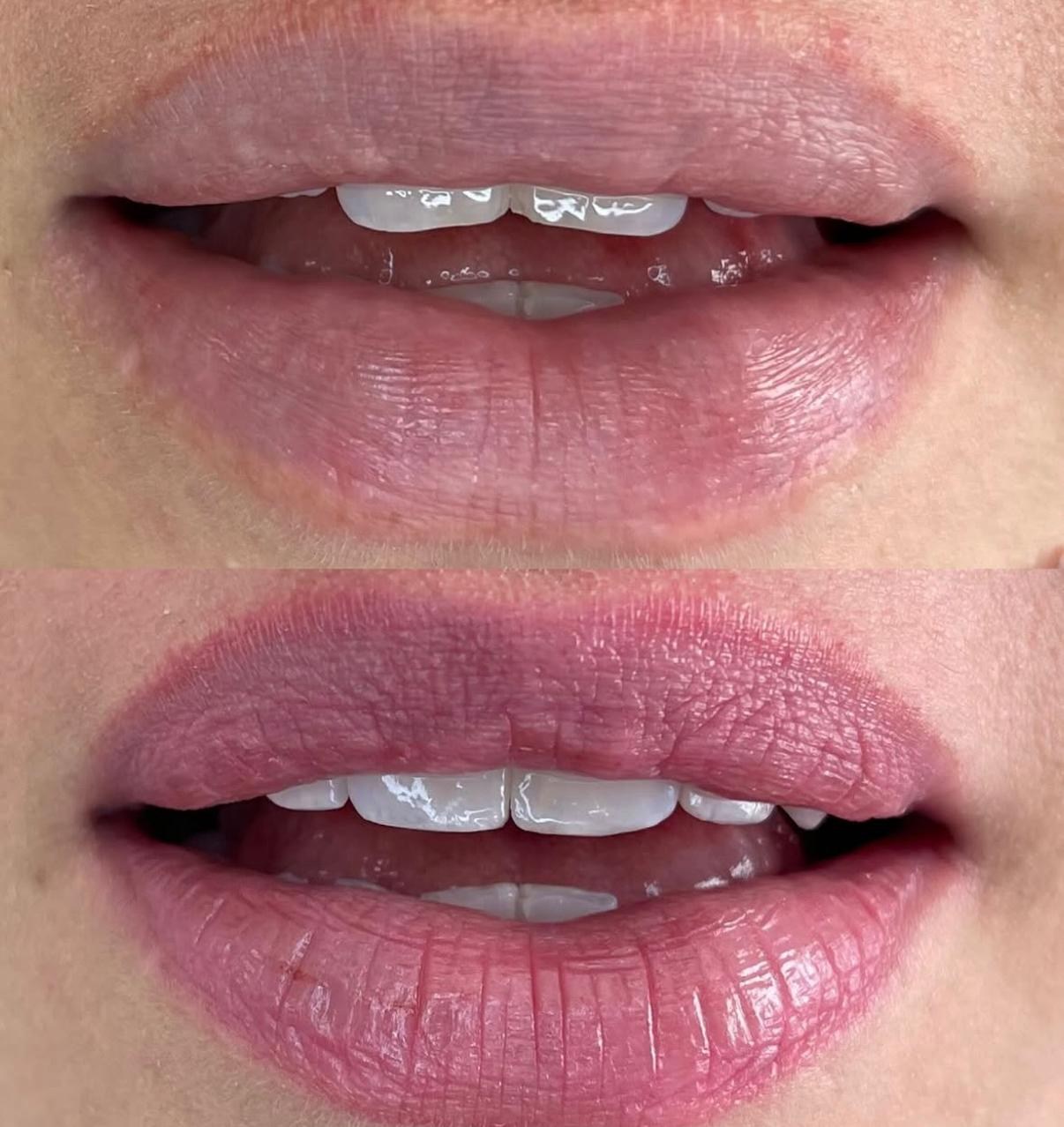 Comparativo clínico do sorriso antes e depois de recontorno estético em resina composta