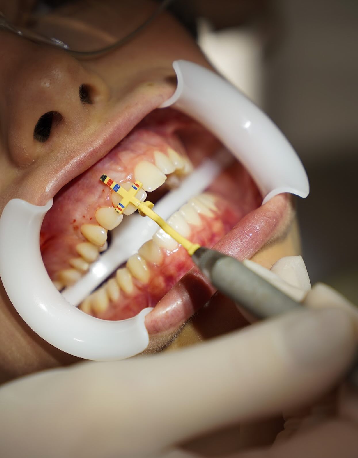 Instrumento de medição utilizado durante o planejamento de uma gengivoplastia