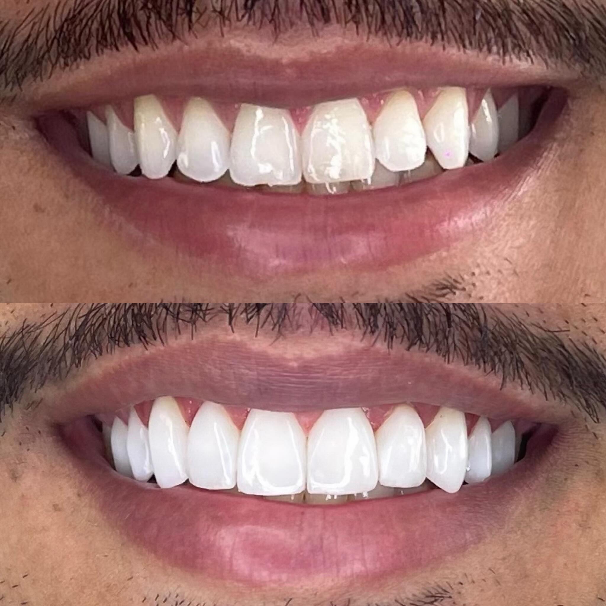 Comparativo clínico do sorriso antes e depois de facetas em resina